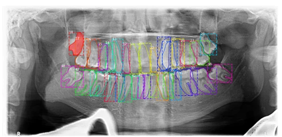 Panoramic dental X-ray with each tooth detected, segmented in color and numbered using FDI notation